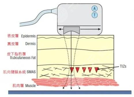 面部除皺術(shù)的價(jià)格是多少