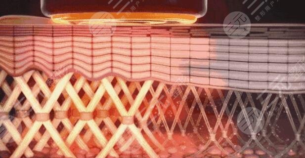 賽諾秀5d膠原光是什么原理