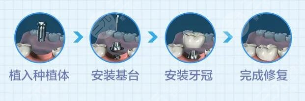 種植牙一般要多長(zhǎng)時(shí)間