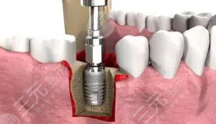 種植牙