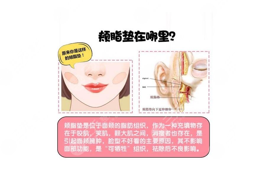 頰脂墊在哪個部位?去掉頰脂墊有什么危害?術(shù)前準(zhǔn)備+術(shù)后護理~