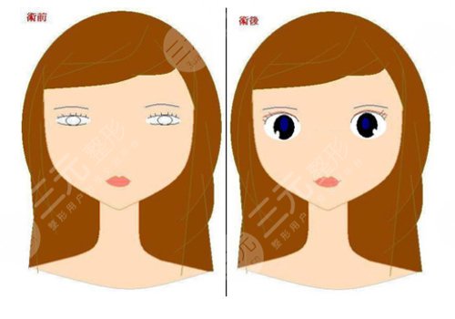 10個(gè)開內(nèi)眼角9個(gè)留疤怎么辦