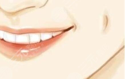 酒窩,再造術(shù),前后,對比,果,圖片