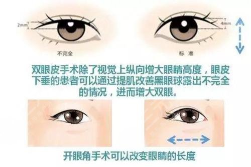 開眼角對比果圖文講解！前后區(qū)別一覽，康康你是否需要do一下！