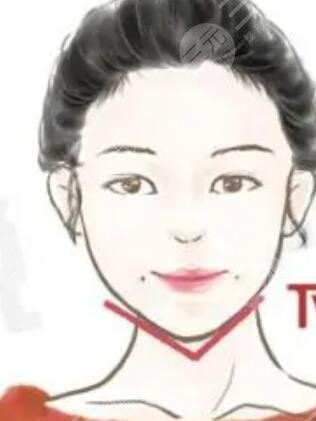 人造酒窩,手術(shù),恢復(fù),過(guò)程,前后,果,對(duì)比,圖片,案例,分享