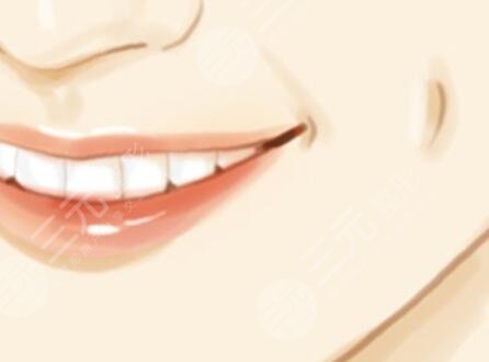 人造酒窩,手術(shù),恢復(fù),過(guò)程,前后,果,對(duì)比,圖片,案例,分享