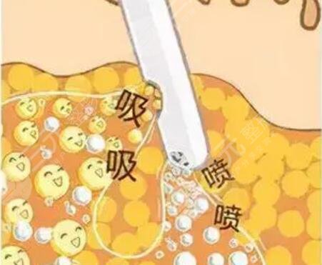 水動力吸脂瘦身減肥整形日記