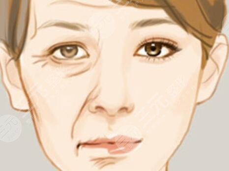 伊w蘭去皺果怎么樣？伊w蘭去皺術(shù)后對(duì)比照1