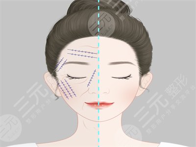 埋埋提升真人整形案例，面部對比果驚艷