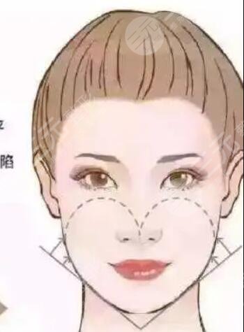 北京偉力嘉美信整形果如何？埋埋提升前后驚人對比