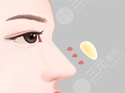 成都素美整形口碑如何？隆鼻整形果對(duì)比分享