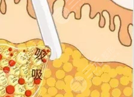 溫州星范吸脂貴不貴？誠享吸脂瘦腿術(shù)后恢復(fù)過程