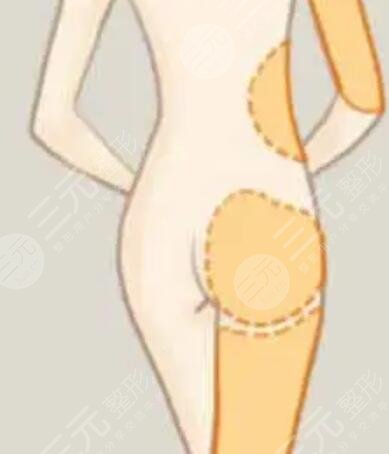 溫州星范吸脂貴不貴？誠享吸脂瘦腿術(shù)后恢復(fù)過程