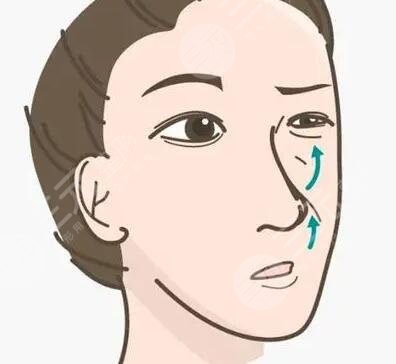 溫州藝星隆鼻整形貴不貴？隆鼻整形術后變美過程分享