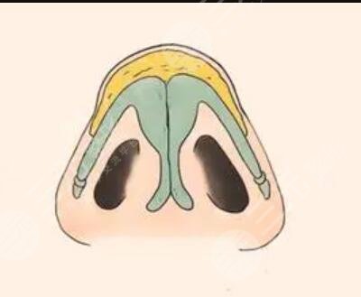 北京壹加壹隆鼻整形案例分享與果對比圖