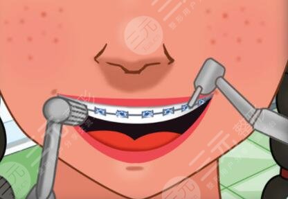 地包天矯正前后對(duì)比照片