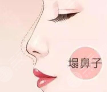 隆鼻整形真人案例 隆鼻整形恢復(fù)過程分享