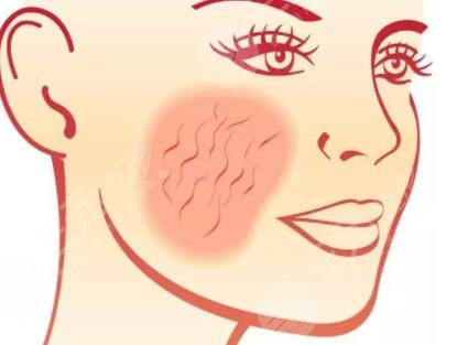 oe光子嫩膚的價格和果