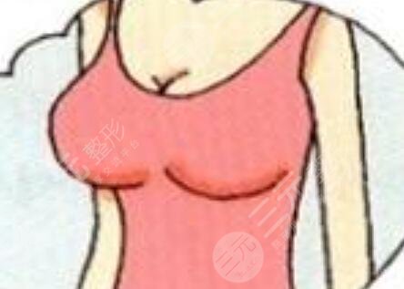 假體隆胸對(duì)比果圖片