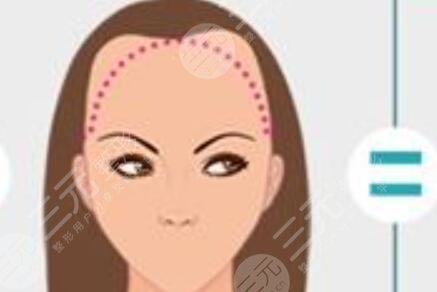 重慶大麥微針植發(fā)醫(yī)院怎么樣