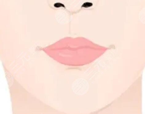 厚唇改薄七天恢復(fù)圖