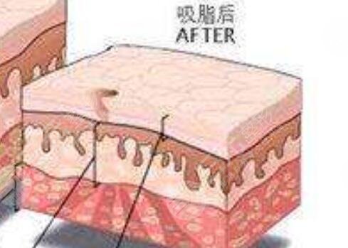 歐洲之星溶脂瘦肚子：術(shù)后第7天