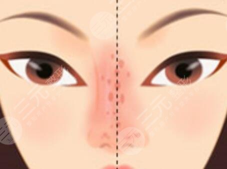 鼻骨內(nèi)推前后對比照