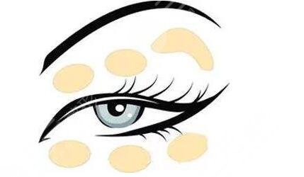 深圳陳芝醫(yī)生雙眼皮修復案例