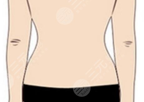 超脂塑溶脂術(shù)后會出現(xiàn)凹凸不平的現(xiàn)象嗎