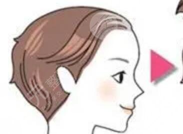 北京熙朵植發(fā)醫(yī)生