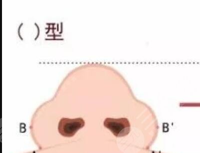 水滴鼻整形圖片