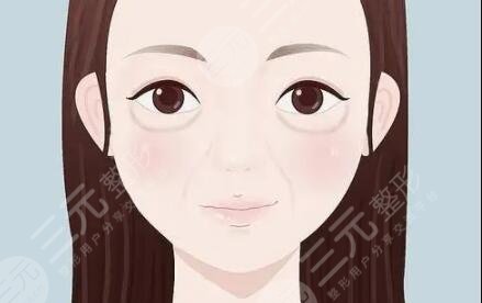 玻尿酸,填充淚溝,圖片對比