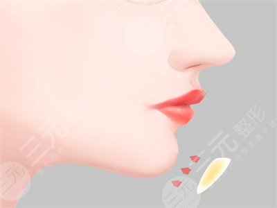 假體墊下巴恢復(fù)過(guò)程圖，讓我的面部有著更標(biāo)準(zhǔn)的比例！