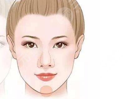 假體墊下巴手術(shù)后兩個(gè)星期