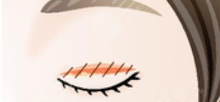 男士割雙眼皮圖片對比