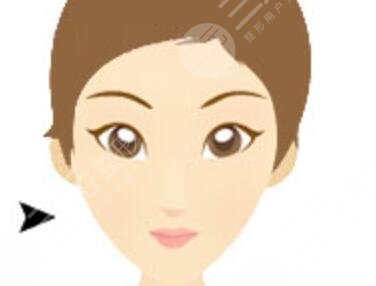 頰脂墊去除手術(shù)后2個月