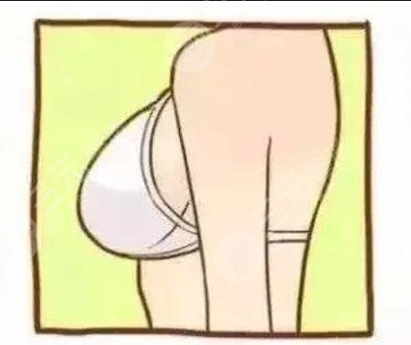 取出假體隆胸后胸部是不是會(huì)特別丑?