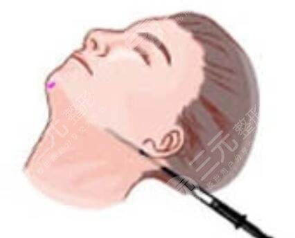 火鳳凰面部溶脂日記前