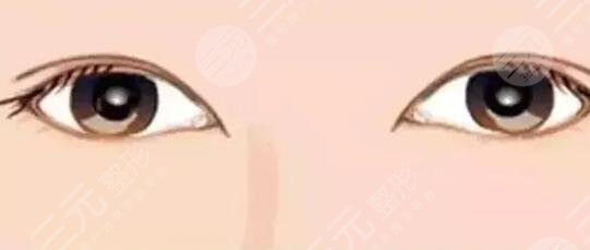 雙眼皮7mm恢復后多寬？來看真人小姐姐的寬度~