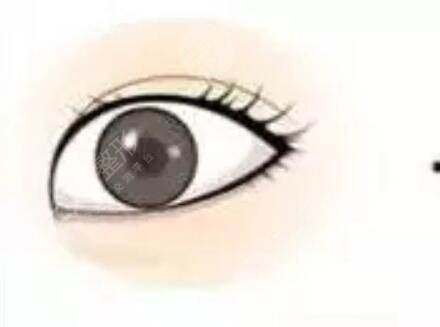 成都八大處胡瓊?cè)A雙眼皮手術(shù)術(shù)后第24天