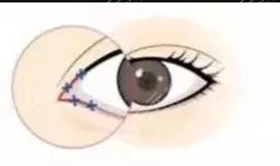 成都八大處胡瓊?cè)A雙眼皮手術(shù)術(shù)后第24天