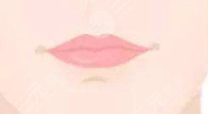 玻尿酸豐唇吸收后能恢復原來的唇型嗎?