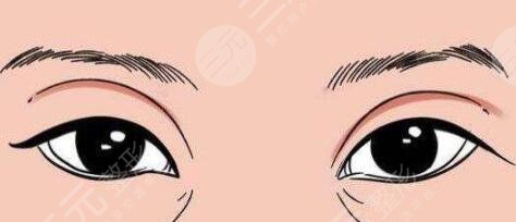 割雙眼皮恢復(fù)過程圖：恢復(fù)過程