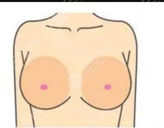 豐胸前后的圖片對(duì)比