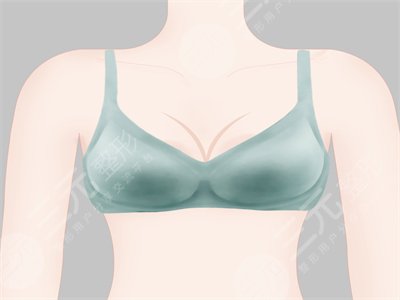 術前胸部扁平不好看