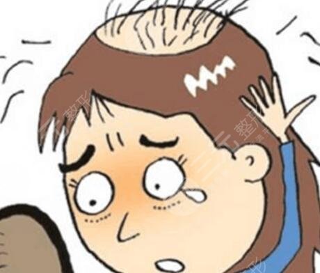 植發(fā)500個(gè)單位能有多大面積呢？看看真人案例圖！