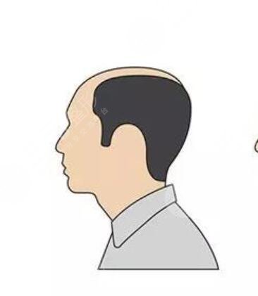 植發(fā)500個(gè)單位能有多大面積呢？看看真人案例圖！