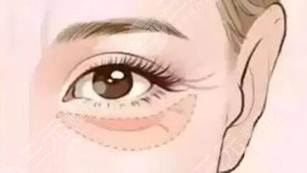 外切眼袋7天恢復(fù)圖