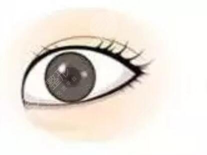 歐式雙眼皮術(shù)后一個月