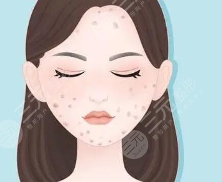 激光去痘印圖片對(duì)比